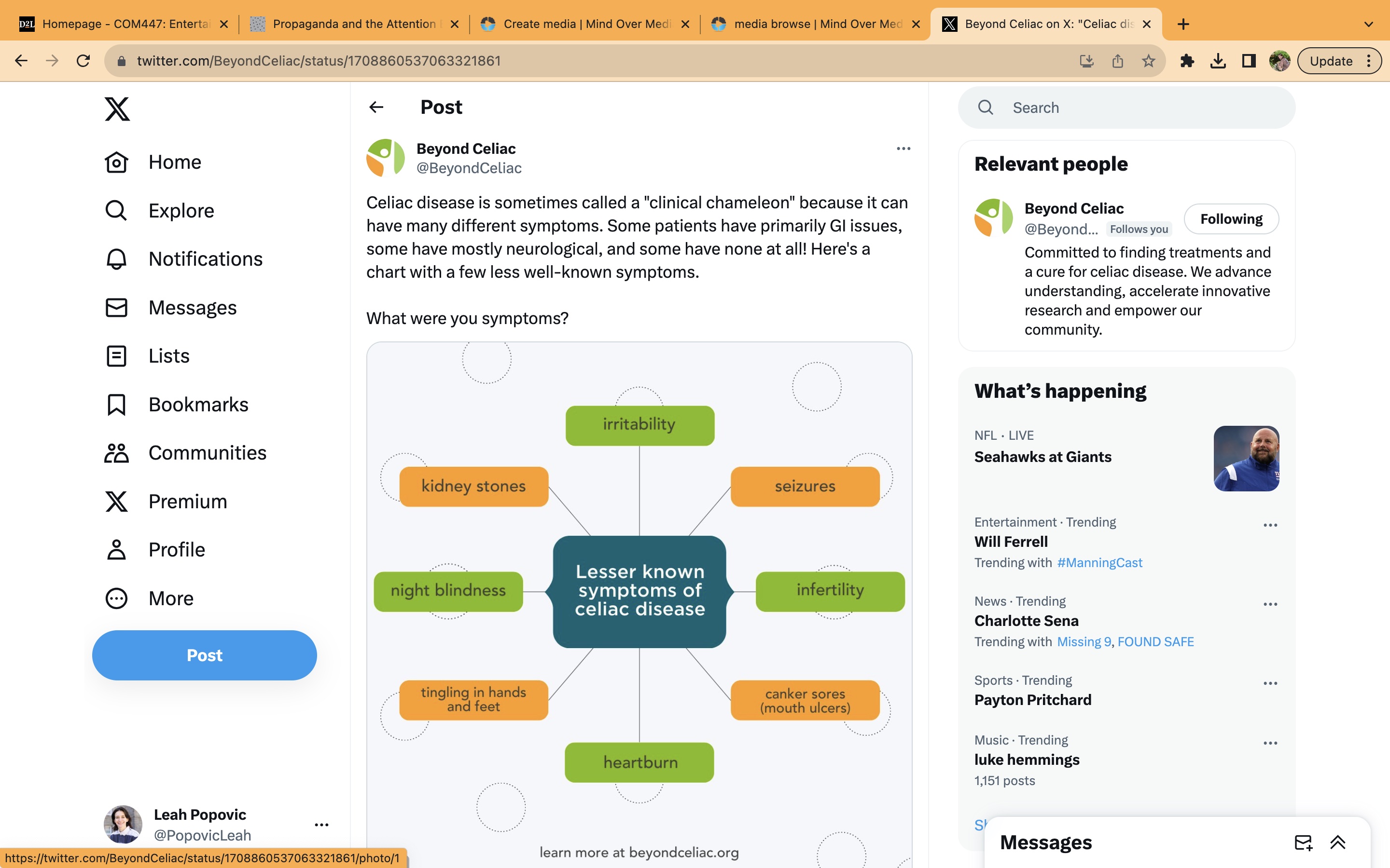 This image shows a chart of some celiac disease symptoms which are lesser known to the public.